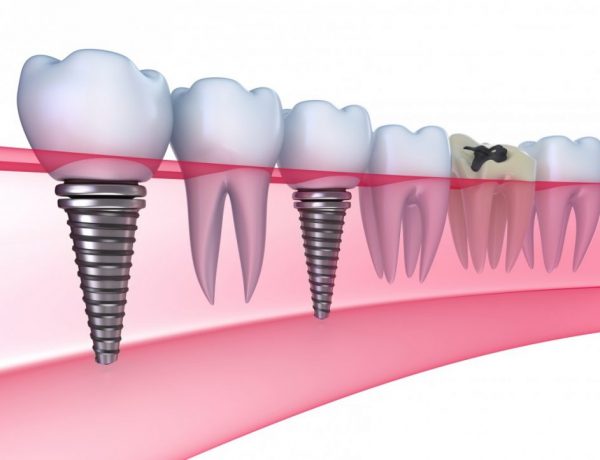 Ce sunt si ce rol au implanturile dentare?