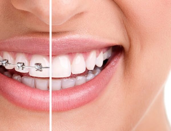 Ce este un aparat dentar?