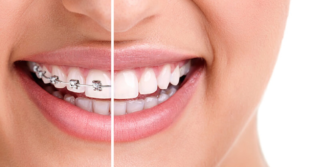Ce este un aparat dentar?