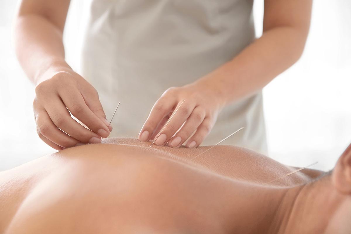 Acupunctura: ce este, pentru ce este, tipuri si cum functioneaza
